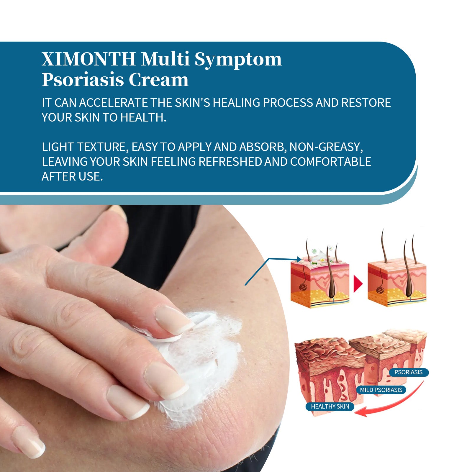 Ximonth Psoriasis Treatment Cream Repair Hand, Foot And Body Moss Redness And Itchy Skin Topical Treatment Cream - 5 - CJ