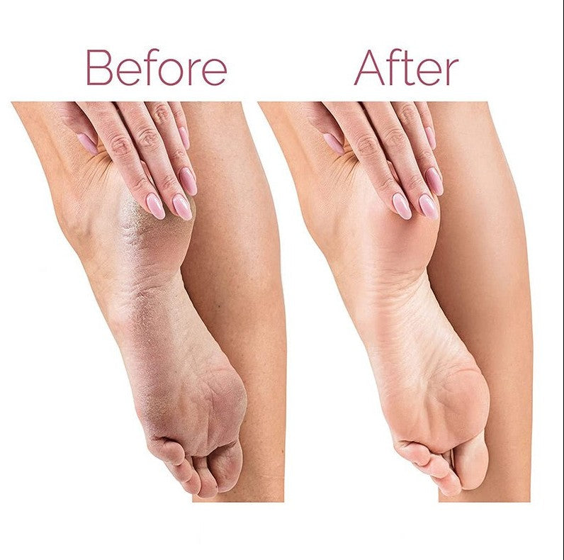 Electric Pedicure Foot File Callus Remover - 5 - CJ