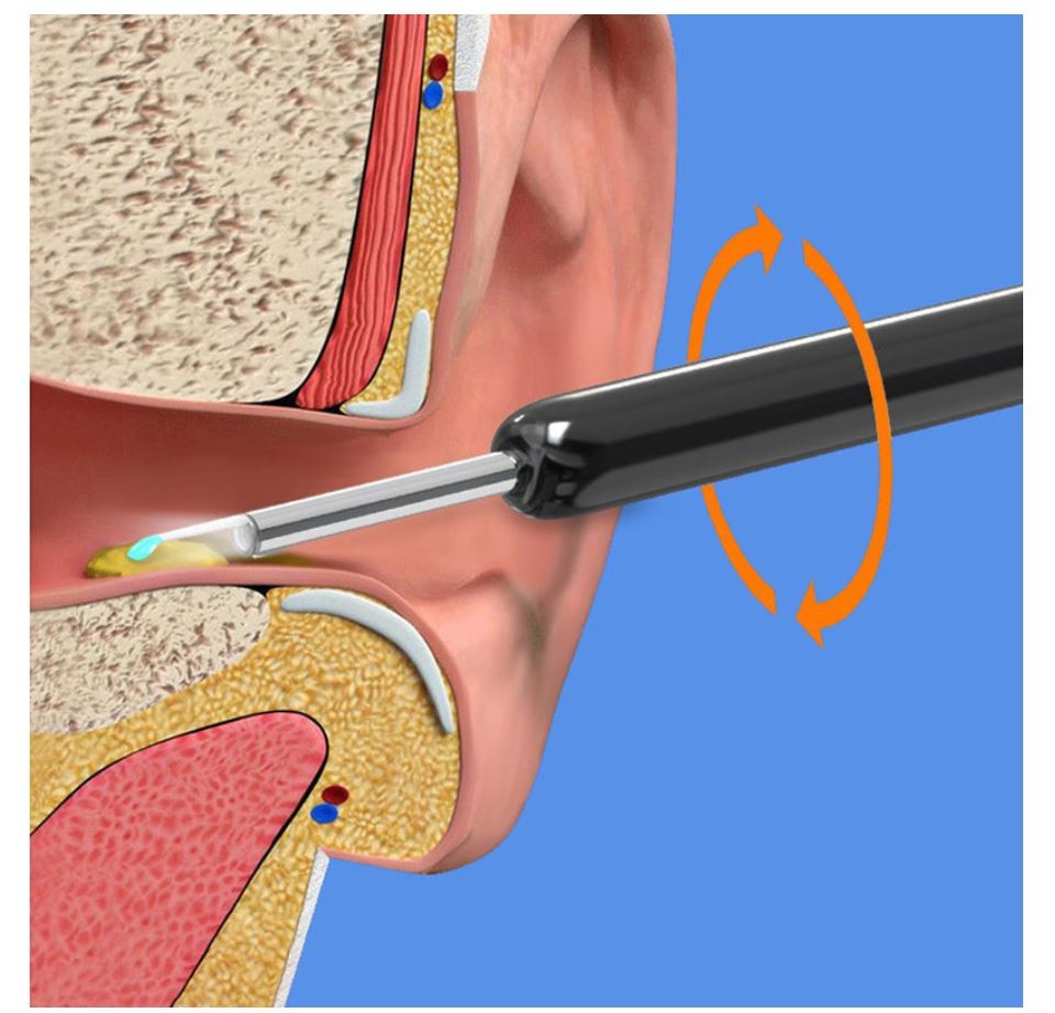 Earwax Removal Kit - 5 - CJ