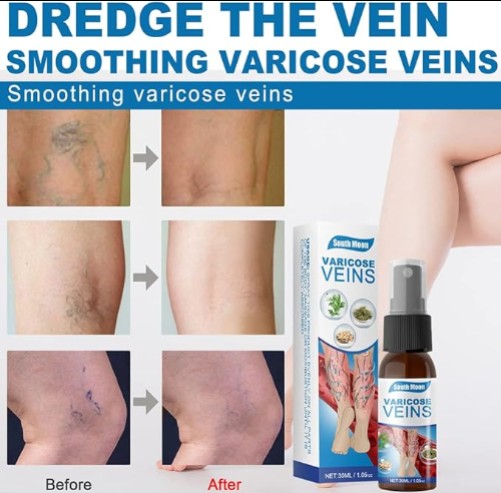 South Moon - Varicose Veins - 5 - CJ