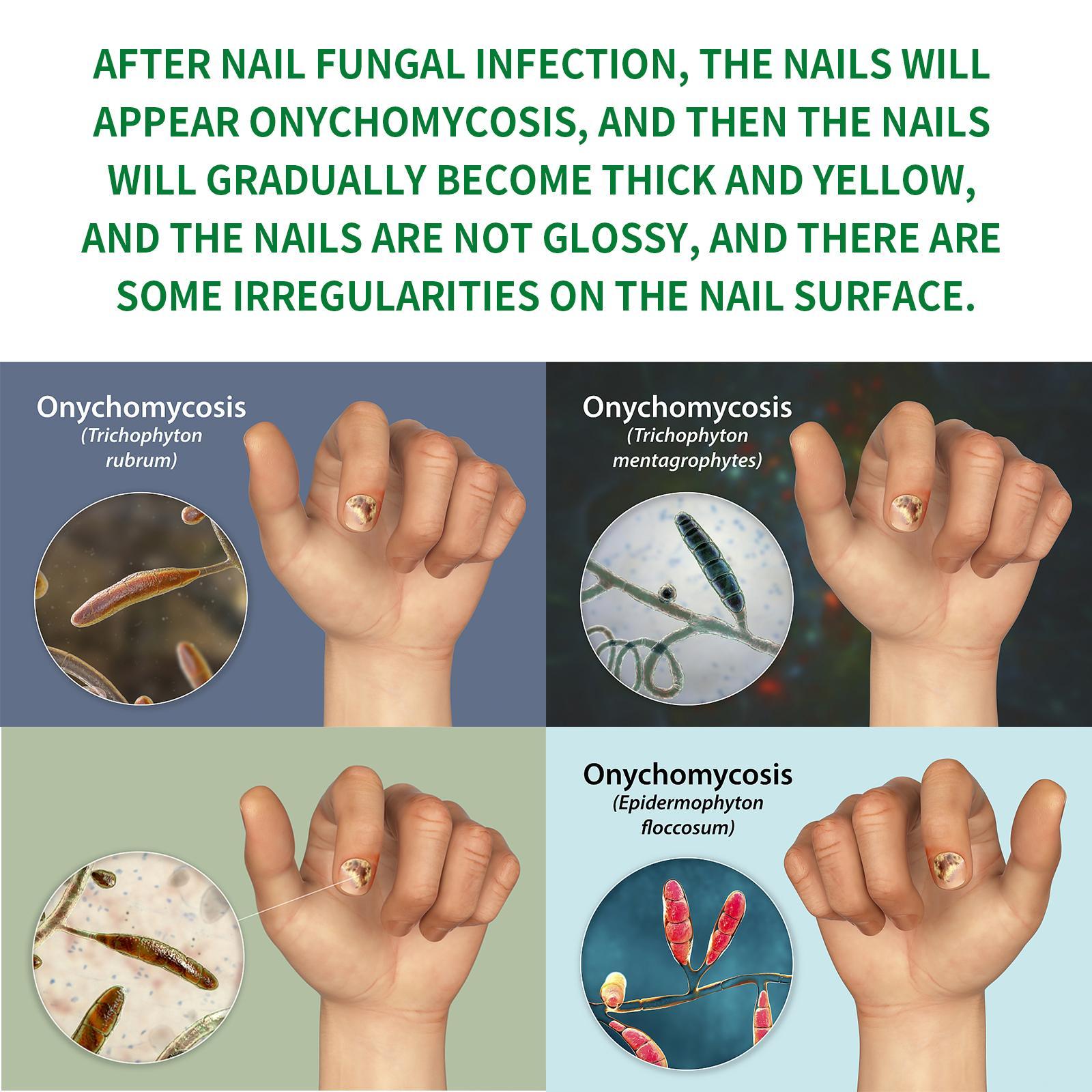 Jiasuying Ginger Nail Care Liquid, Repairs And Moisturizes Hand And Foot Nails, Makes Nails Shiny And Soft, And Improves Onychomycosis - 5 - CJ