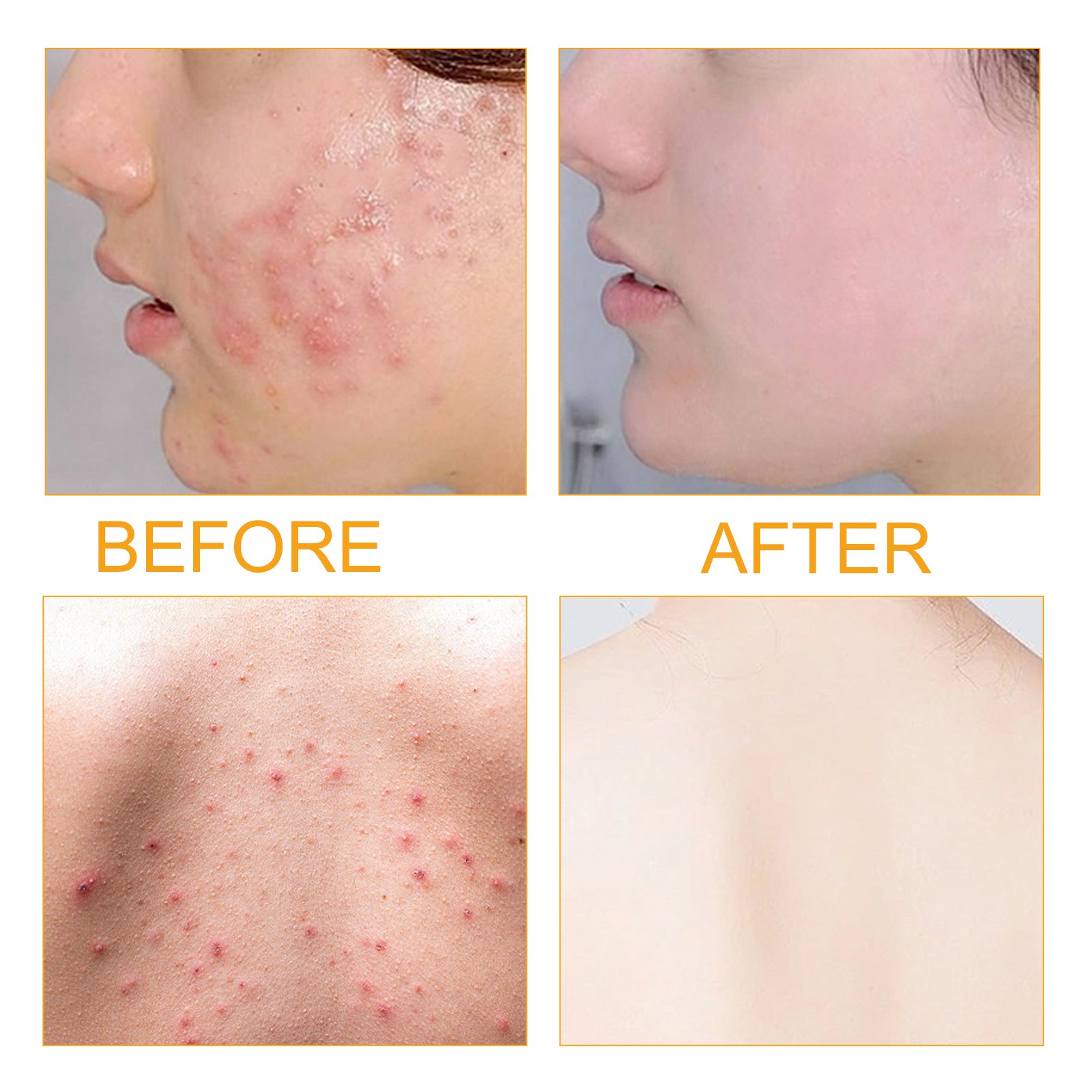 Jayusing Anti - Acne And Anti - Acne Serum, Reduce Acne And Acne Mark Moisturizing Skin Repair Serum - 5 - CJ