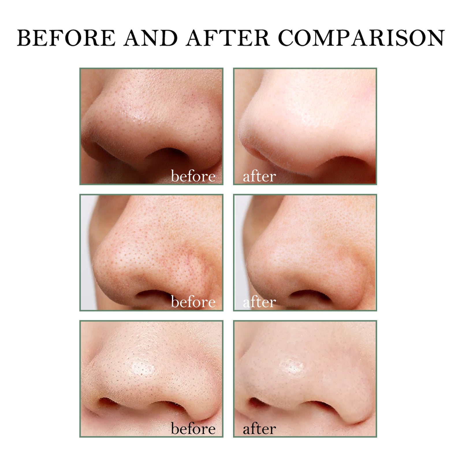 Blackhead Remover Tools - 15g Blackhead Creamwith 40Pcs Blackhead Pore Strips - 5 - CJ