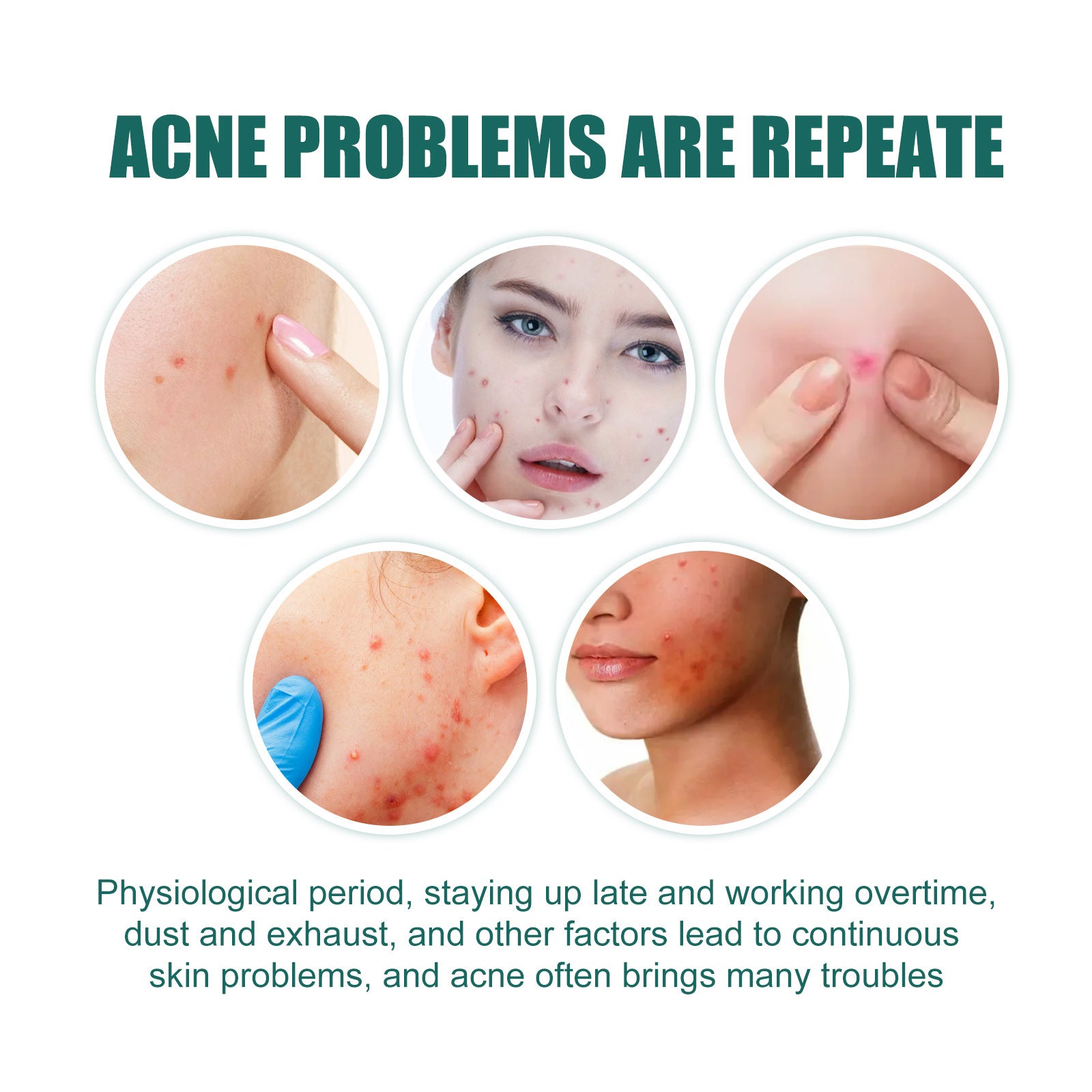 EELHOE Love Acne Patch Gentle Cleansing Acne Patch Fades Facial Acne Marks And Spots Facial Cleansing Care - 5 - CJ