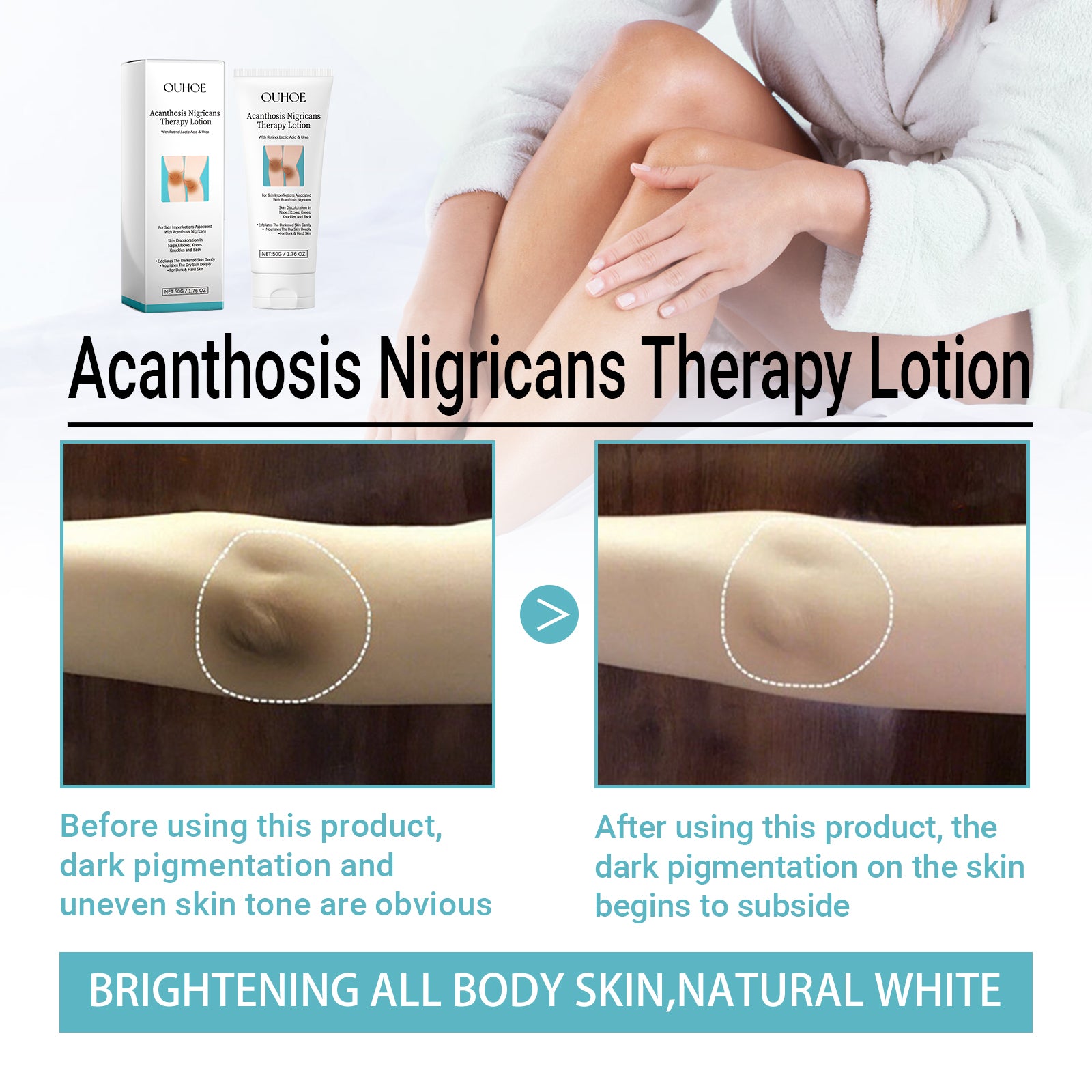 OUHOE Acanthosis Nigricans Therapy Lotion, Skin Moisturizing Clean Black Dark Heavy Alar Knee Joint Repair Carry Bright Color Of Skin - 5 - CJ