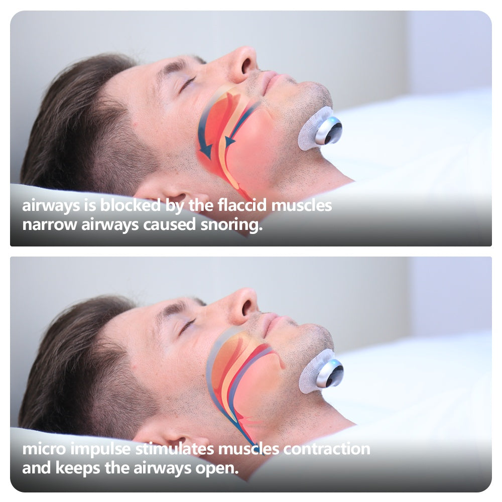 Smart Anti Snoring Device Electronic Muscle Stimulator - 5 - CJ