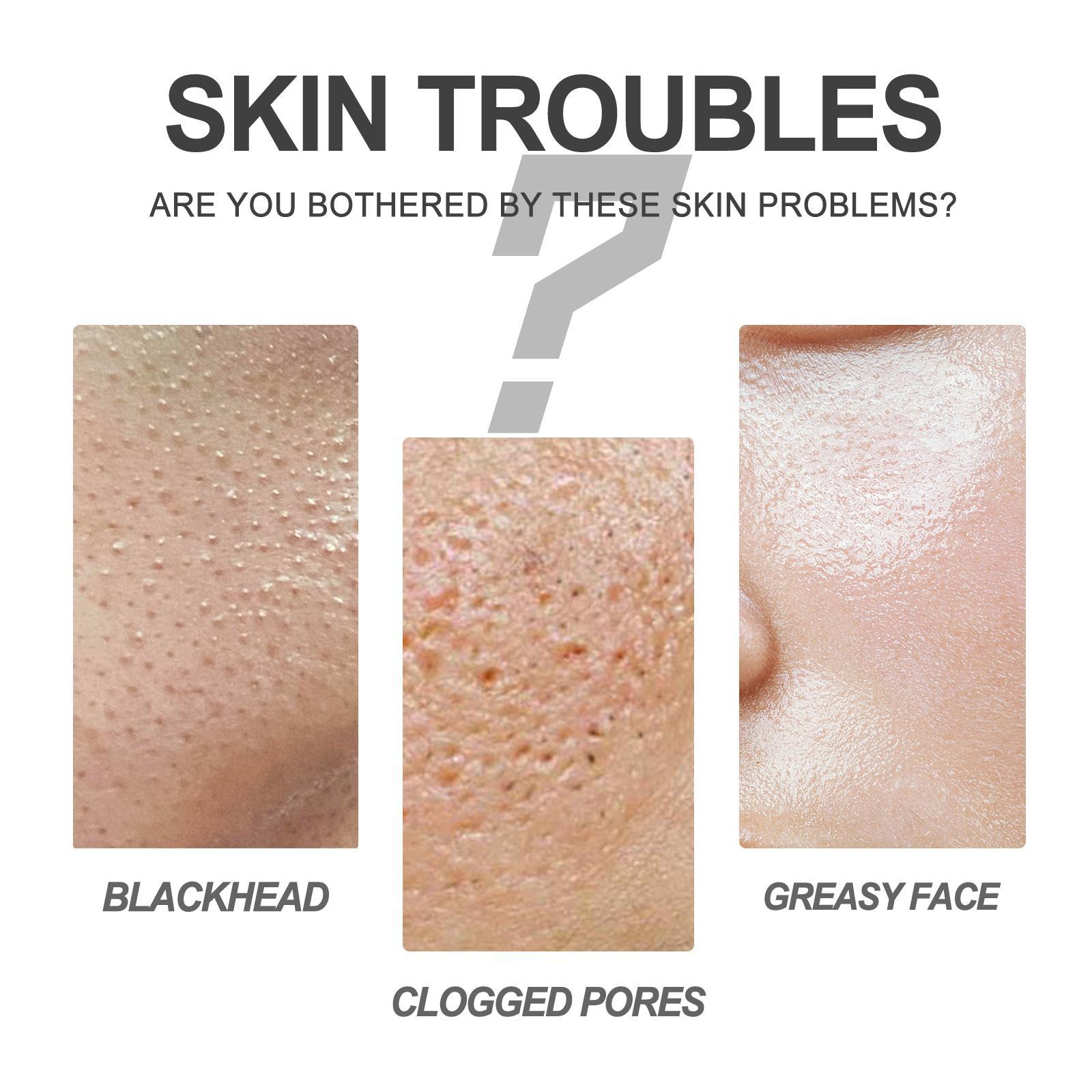 Blackhead Cleansing Cream Exfoliating, Cleaning And Repairing Pores Solve Skin Oil, Blackhead And Acne Problems Peel - off Nose Patch - 5 - CJ