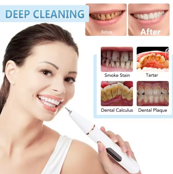 Smart Ultra - Sonic Teeth Cleaner - 5 - CJ
