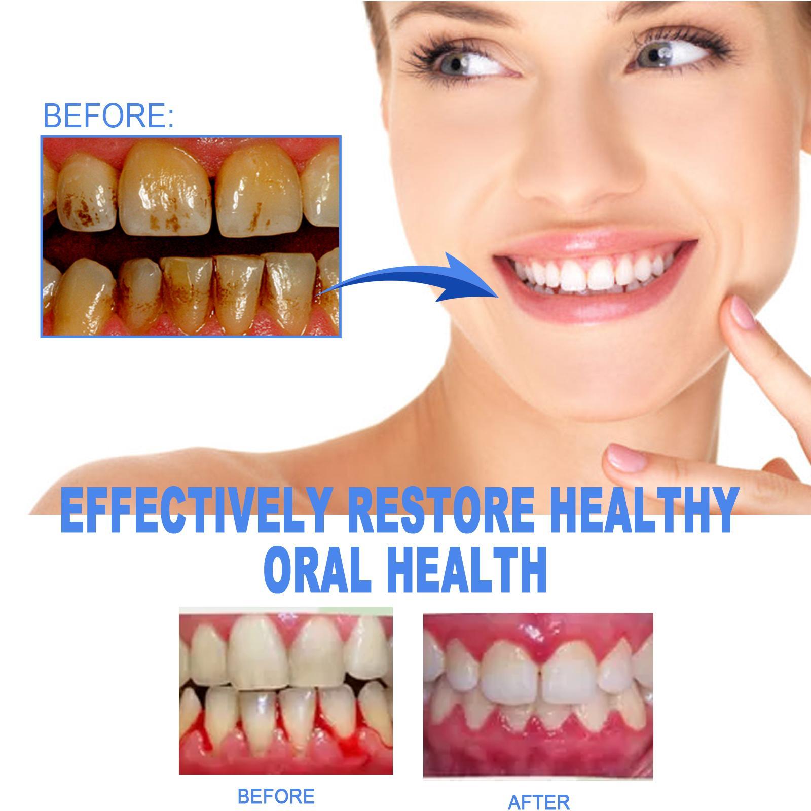 Yierhao Tooth Repair Gel, Repair Gums, Clean Teeth Stains, Tartar, Oral Care - 5 - CJ