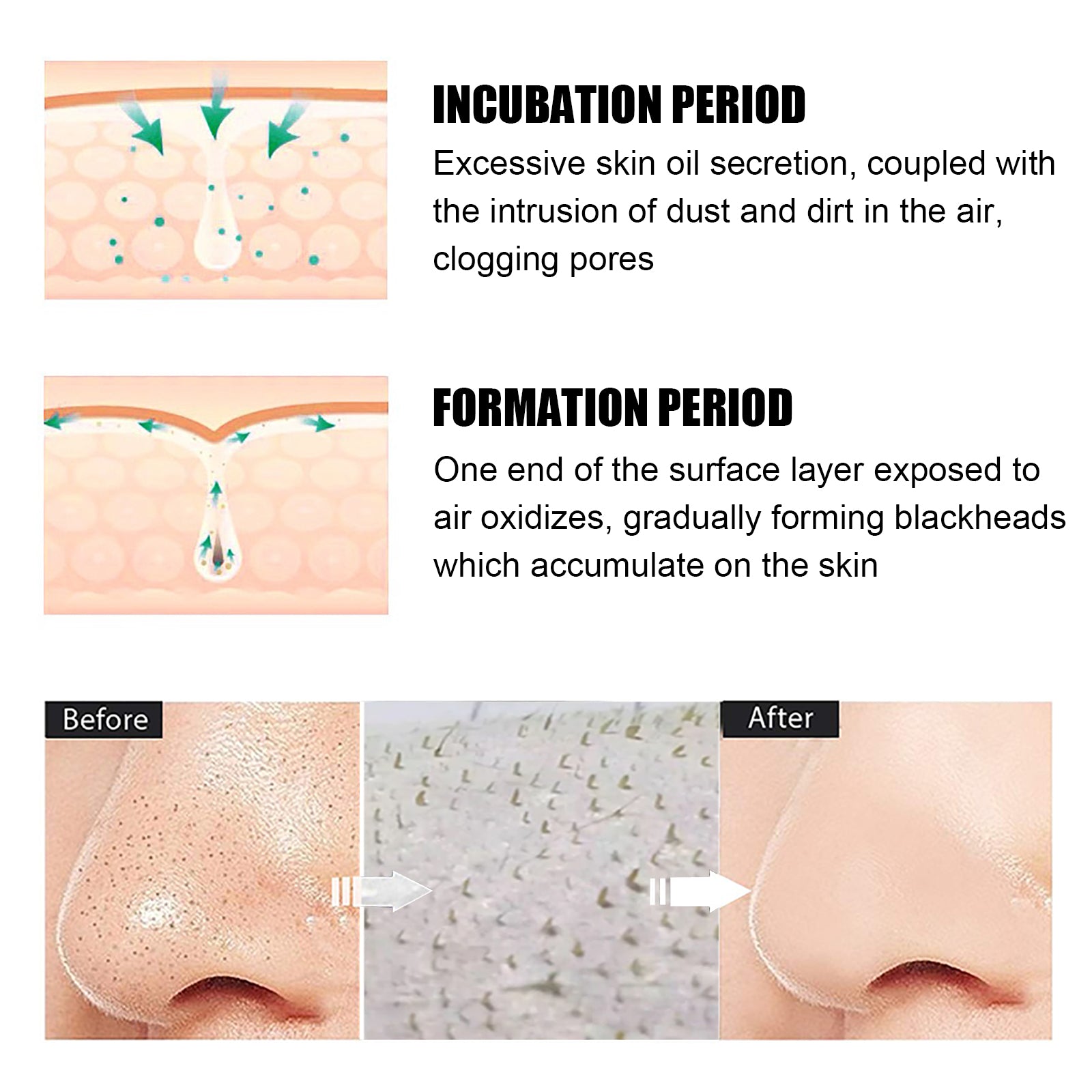 Blackhead Remover Tools - 15g Blackhead Creamwith 40Pcs Blackhead Pore Strips - 5 - CJ