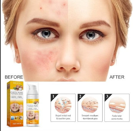 Eelhoe - Cystic Acne Cream - 5 - CJ