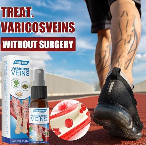 South Moon - Varicose Veins - 5 - CJ