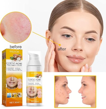 Eelhoe - Cystic Acne Cream - 5 - CJ
