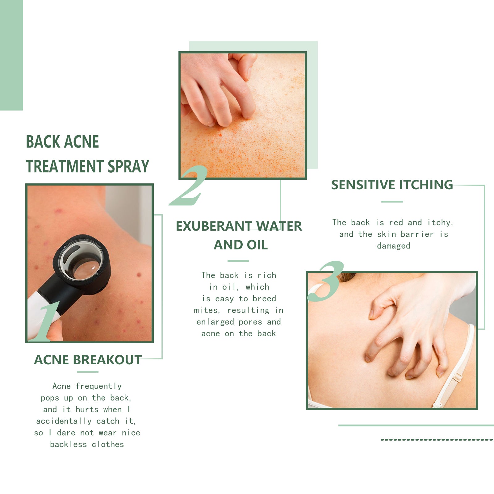 Jaysuing Back Acne Repair Spray, Repair Body Acne Fade Acne Mark Skin Care Spray - 5 - CJ