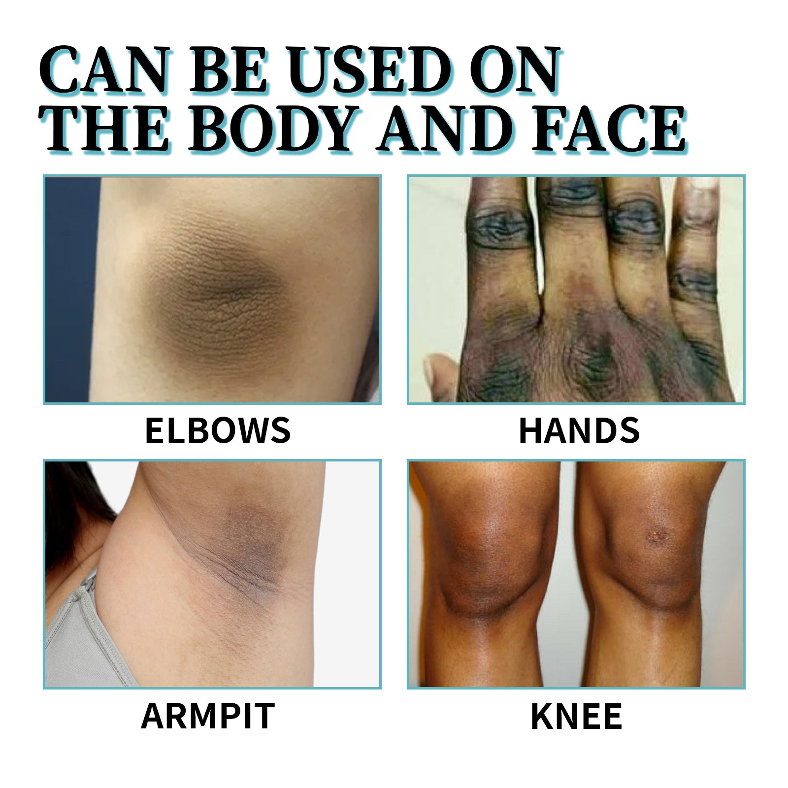 OUHOE Acanthosis Nigricans Therapy Lotion, Skin Moisturizing Clean Black Dark Heavy Alar Knee Joint Repair Carry Bright Color Of Skin - 5 - CJ