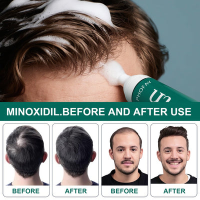 CH004 Minoxidil Anti - Hair Loss Mousse - 4 - CJ