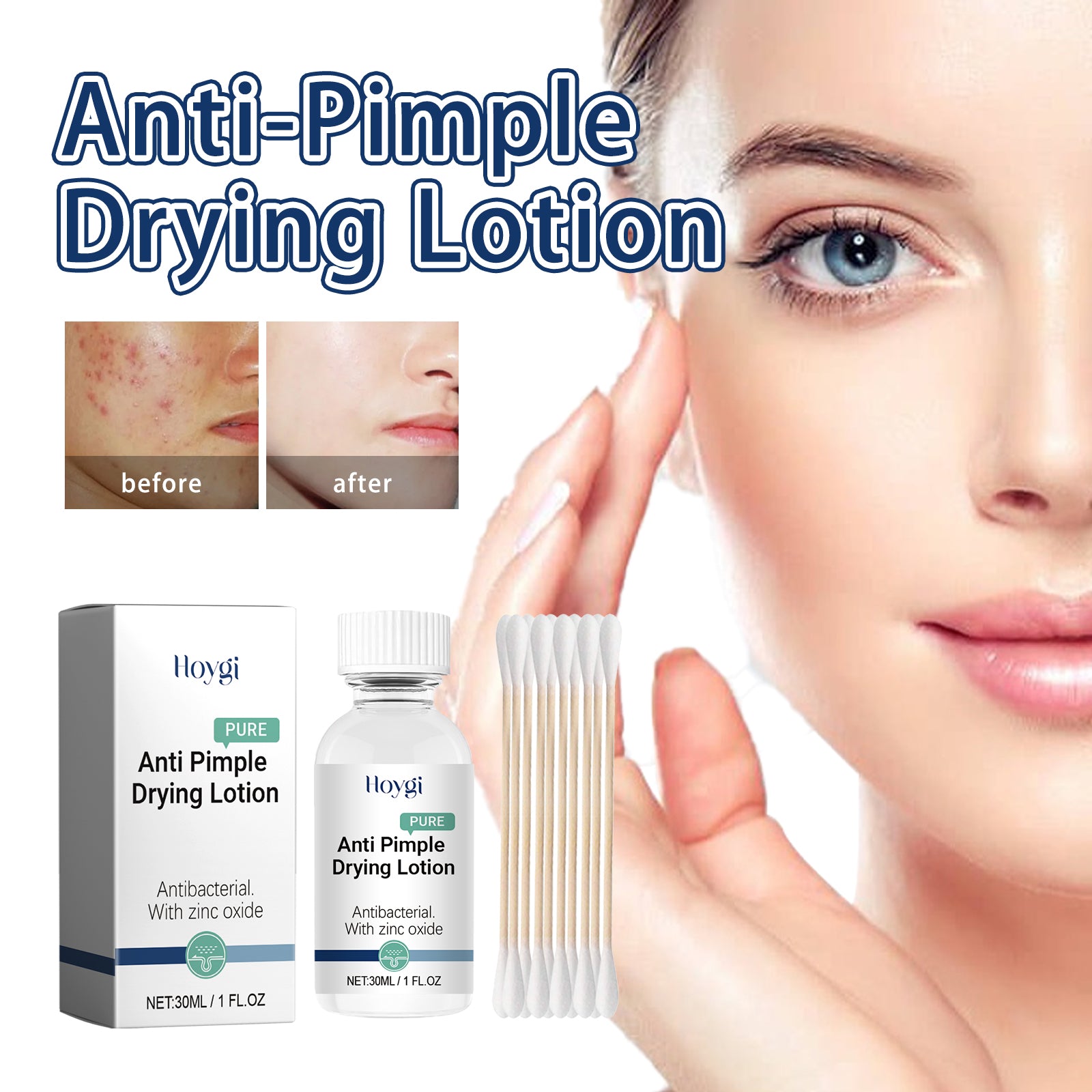 Hoygi Anti - Pimple Drying Lotion, Facial Cleansing And Repair Lighten Acne Marks And Pits, Close Your Mouth And Mild Skin Cream - 5 - CJ