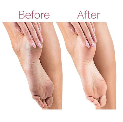 Electric Pedicure Foot File Callus Remover - 5 - CJ