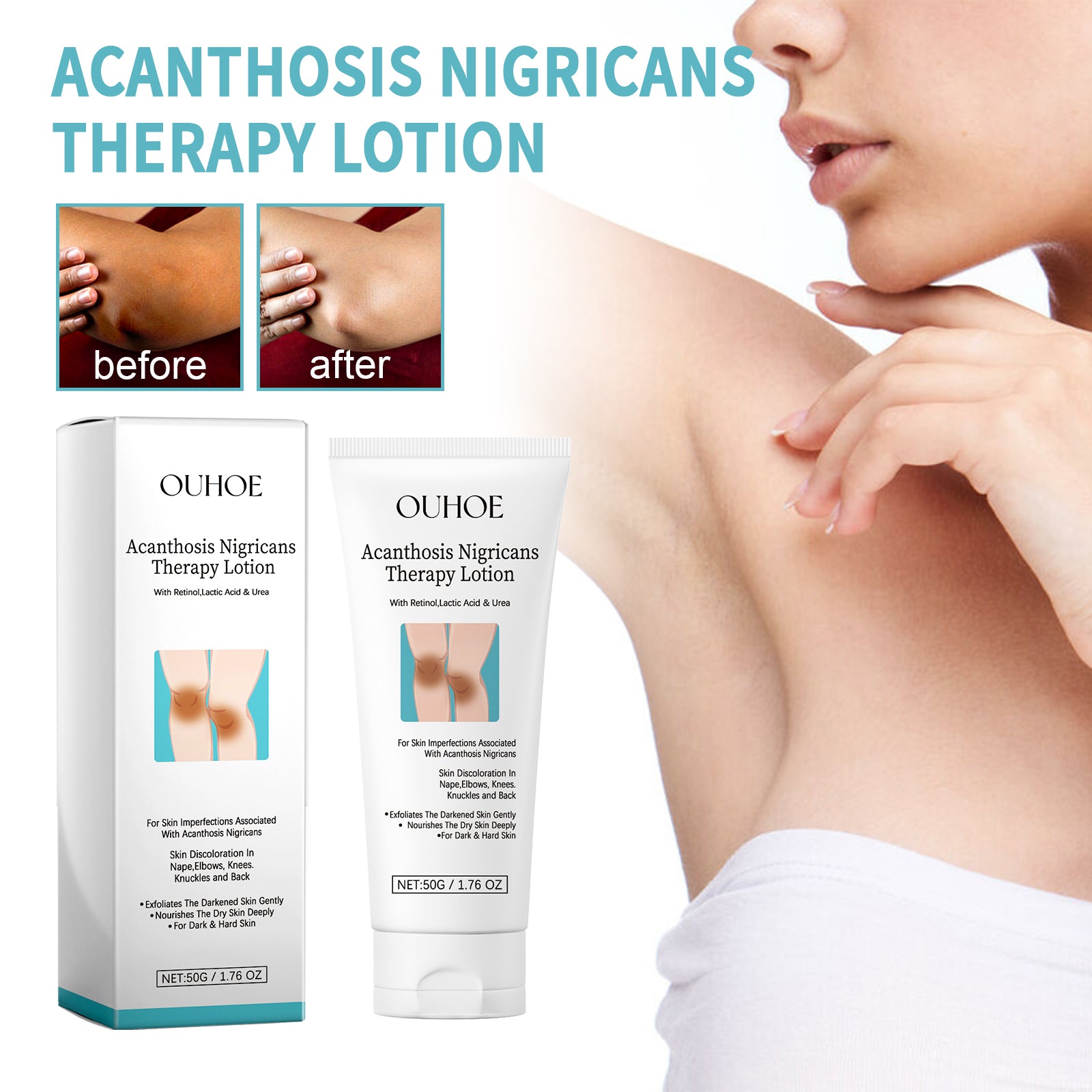 OUHOE Acanthosis Nigricans Therapy Lotion, Skin Moisturizing Clean Black Dark Heavy Alar Knee Joint Repair Carry Bright Color Of Skin - 5 - CJ
