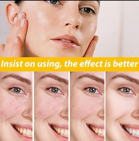 Eelhoe - Cystic Acne Cream - 5 - CJ