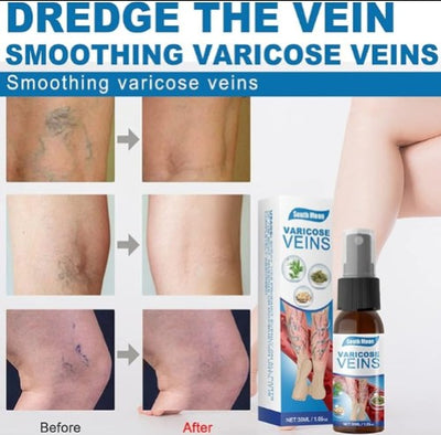 South Moon - Varicose Veins - 5 - CJ