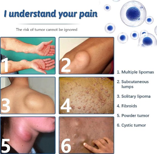 South Moon - Lipoma Removal Spray - 5 - CJ