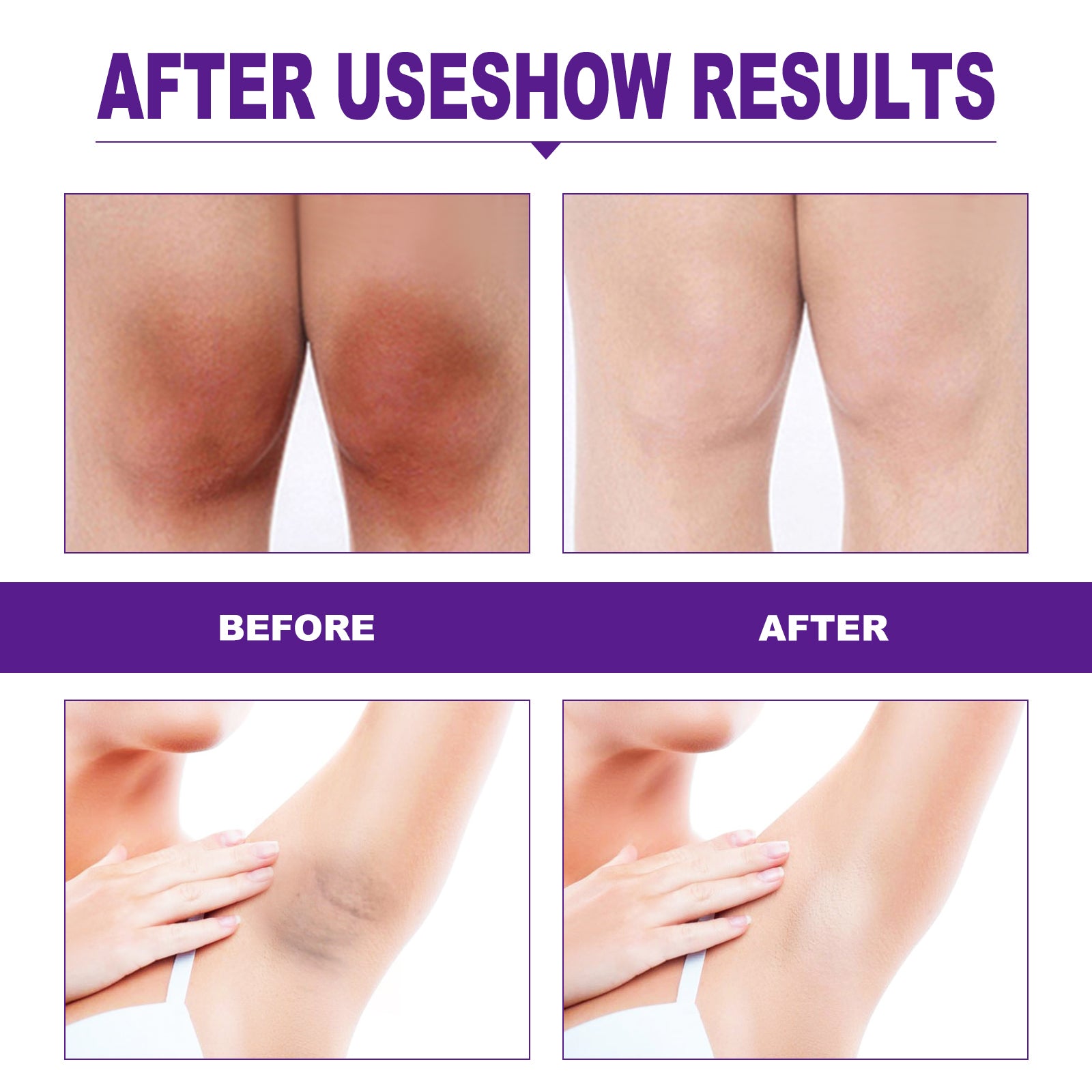 EELHOE Rejuvenator Areola Intimate Area Rejuvenator Lip Joints Melanin Removal - 5 - CJ