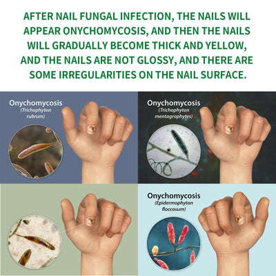 Jiasuying Ginger Nail Care Liquid, Repairs And Moisturizes Hand And Foot Nails, Makes Nails Shiny And Soft, And Improves Onychomycosis - 5 - CJ