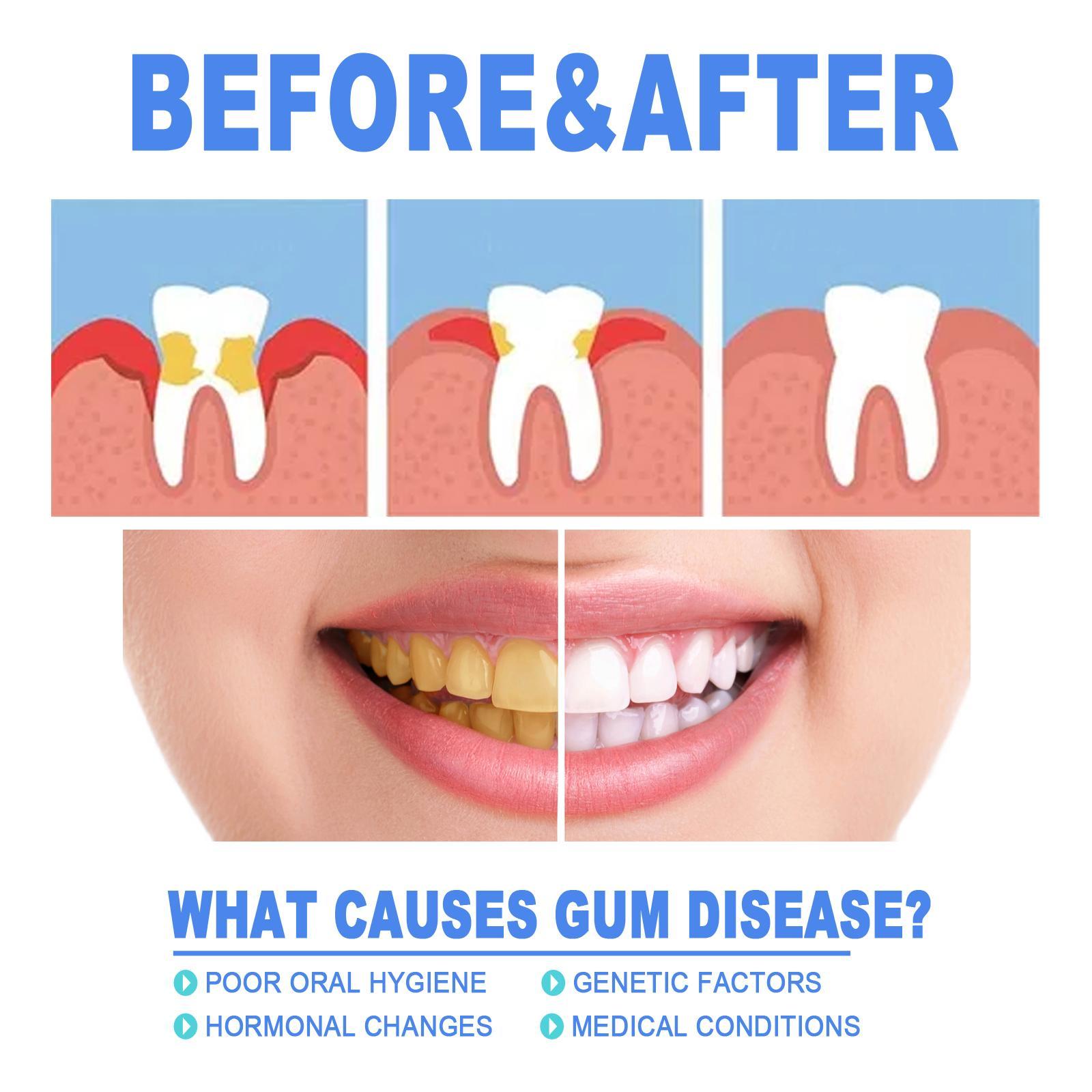 Yierhao Tooth Repair Gel, Repair Gums, Clean Teeth Stains, Tartar, Oral Care - 5 - CJ