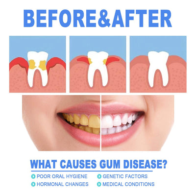Yierhao Tooth Repair Gel, Repair Gums, Clean Teeth Stains, Tartar, Oral Care - 5 - CJ
