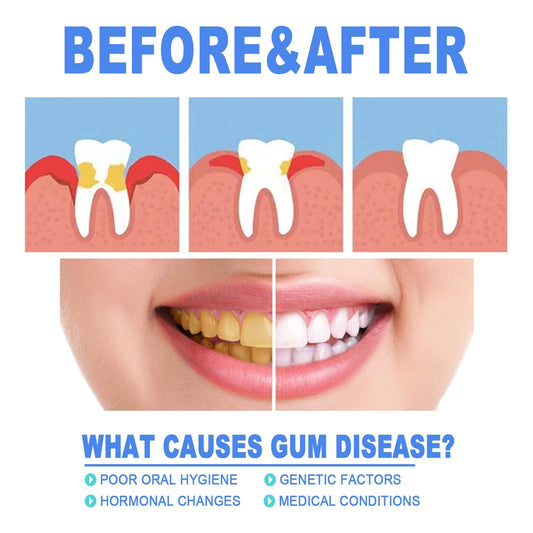 Yierhao Tooth Repair Gel, Repair Gums, Clean Teeth Stains, Tartar, Oral Care - 5 - CJ