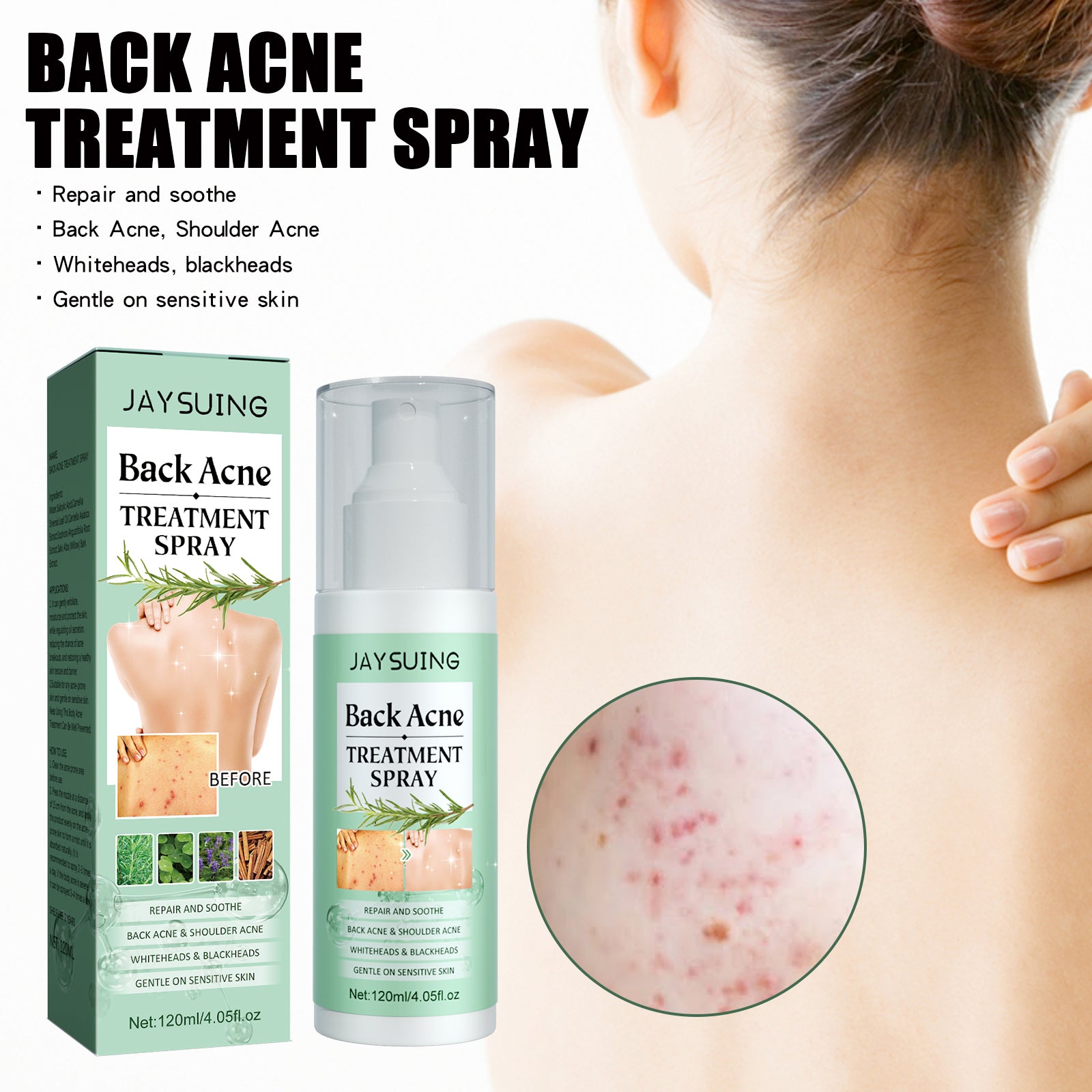 Jaysuing Back Acne Repair Spray, Repair Body Acne Fade Acne Mark Skin Care Spray - 5 - CJ