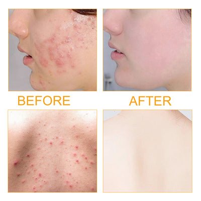 Jayusing Anti - Acne And Anti - Acne Serum, Reduce Acne And Acne Mark Moisturizing Skin Repair Serum - 5 - CJ