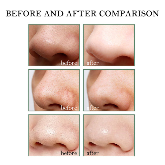 Blackhead Remover Tools - 15g Blackhead Creamwith 40Pcs Blackhead Pore Strips - 5 - CJ