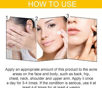 Eelhoe - Cystic Acne Cream - 5 - CJ