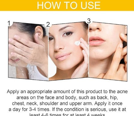 Eelhoe - Cystic Acne Cream - 5 - CJ