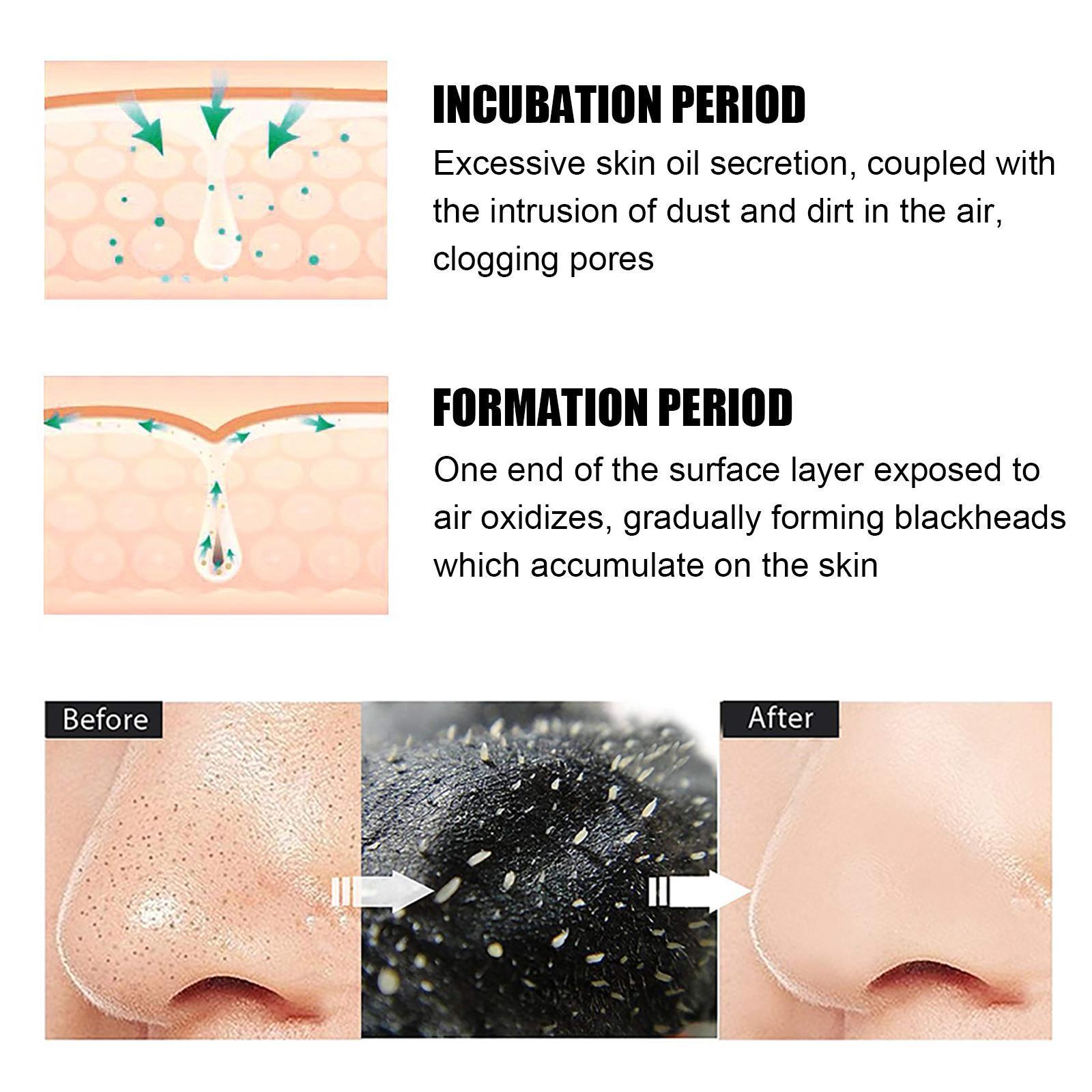 10 Pcs Blackhead Nose Patch Nose Pore Cleansing Strips Deep Cleansing Blackhead Remover Strips For Women Men - 5 - CJ