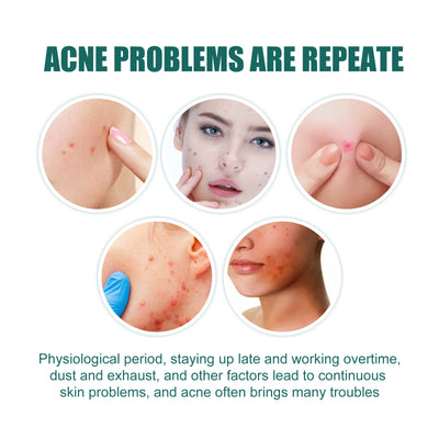 EELHOE Love Acne Patch Gentle Cleansing Acne Patch Fades Facial Acne Marks And Spots Facial Cleansing Care - 5 - CJ