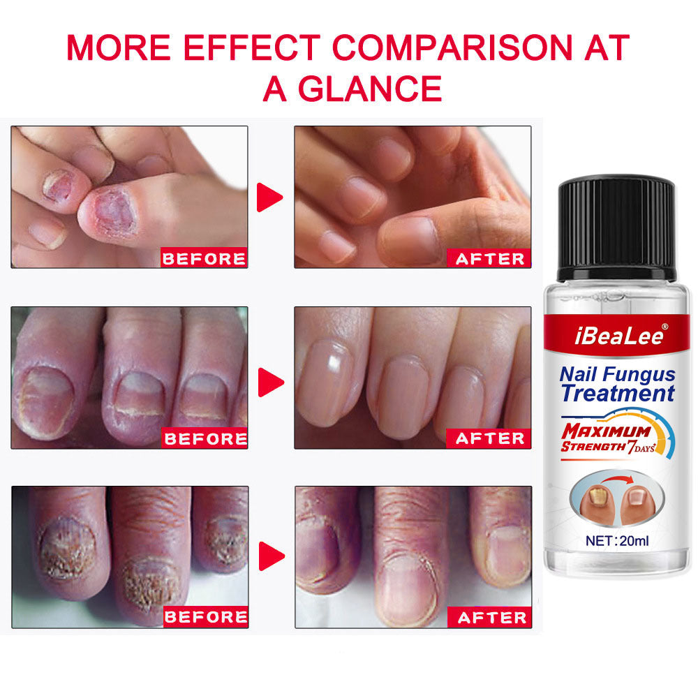 Thickening Of Special Bacteriostatic Liquid For Onychomycosis - 0 - CJ