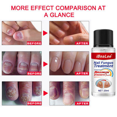 Thickening Of Special Bacteriostatic Liquid For Onychomycosis - 0 - CJ
