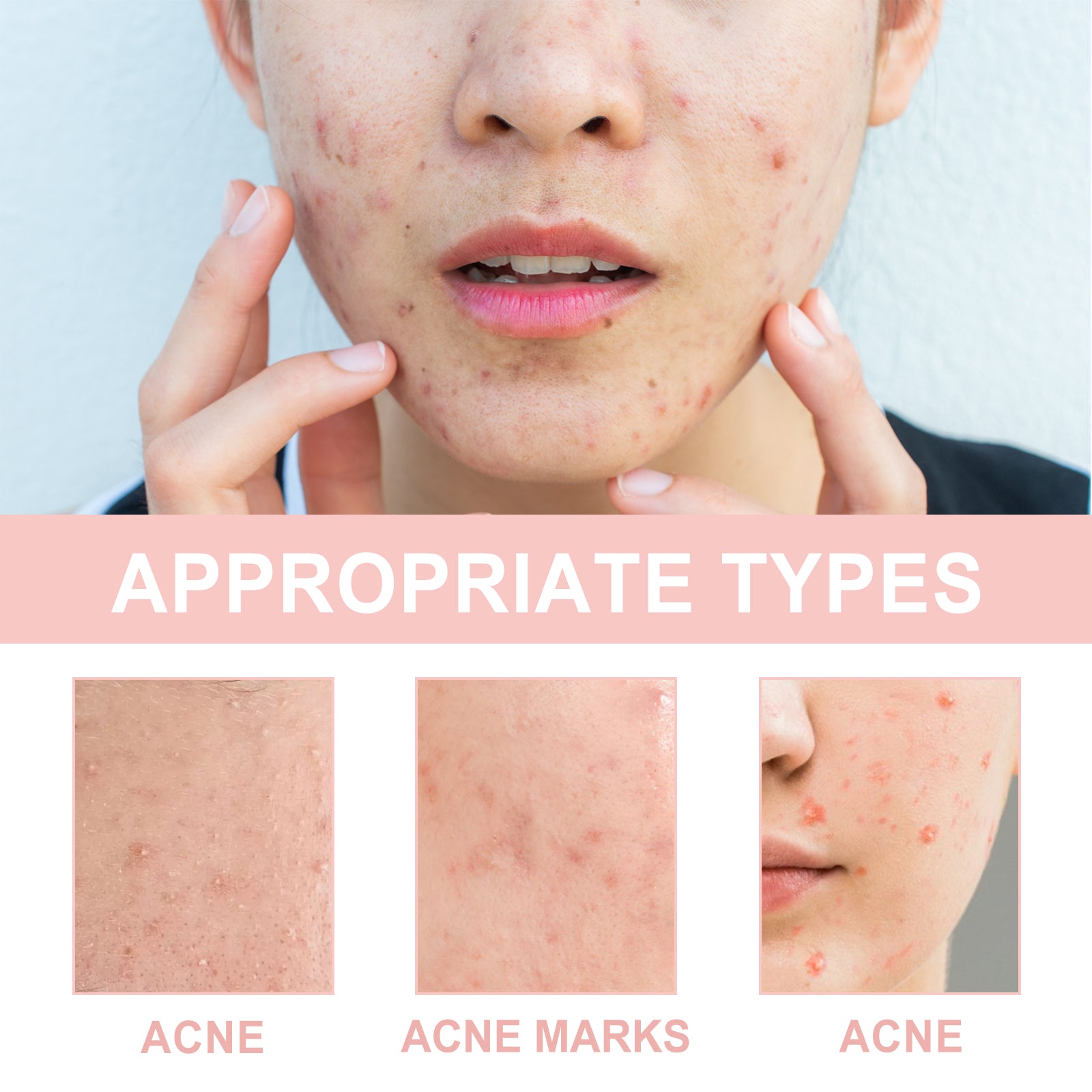 OUHOE Acne Patch Repair Acne Acne Redness Pore Cleansing & Moisturizing Patch - 5 - CJ