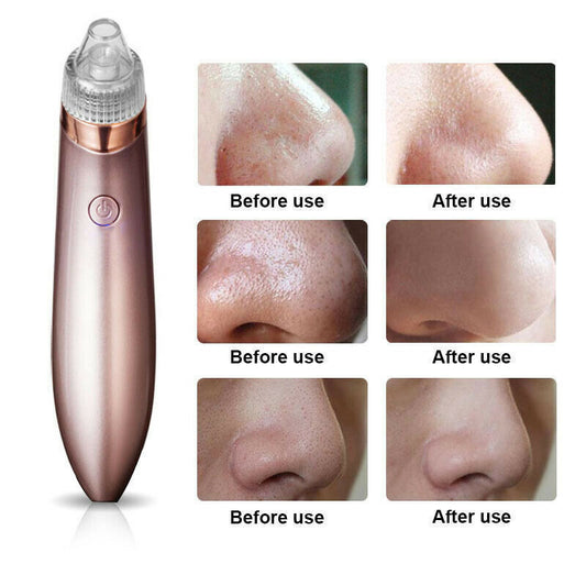 Electric Blackhead Vacuum Pore Cleaner Acne Pimple Remover Strong Suction Tool Electric Blackhead Remover Pore Vacuum Suction Diamond Dermabrasion Face Cleaner - 5 - CJ