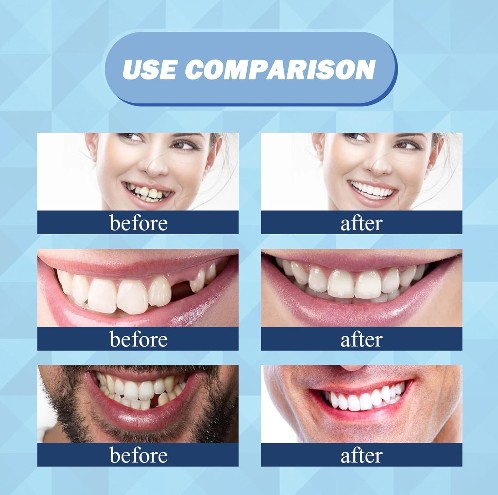 Eelhoe - Thermal Forming False Teeth - 5 - CJ