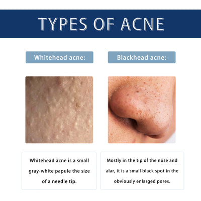 Hoygi Anti - Pimple Drying Lotion, Facial Cleansing And Repair Lighten Acne Marks And Pits, Close Your Mouth And Mild Skin Cream - 5 - CJ