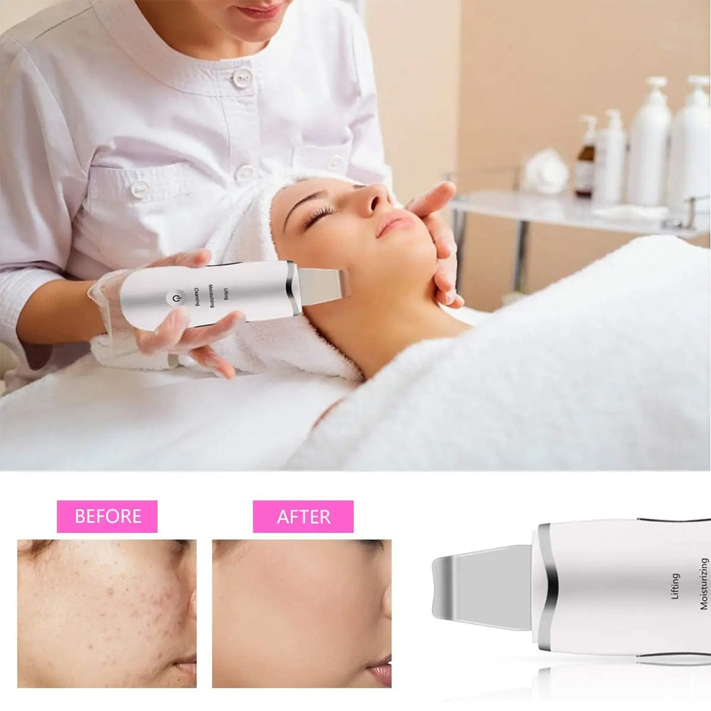 3 - in - 1 Ultrasonic Facial Spatula For Deep Cleansing, Electric Ultrasonic Skin Scrubber - 5 - CJ