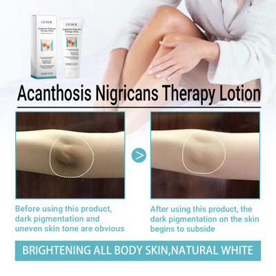 OUHOE Acanthosis Nigricans Therapy Lotion, Skin Moisturizing Clean Black Dark Heavy Alar Knee Joint Repair Carry Bright Color Of Skin - 5 - CJ