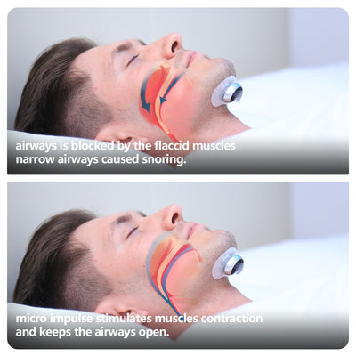 Smart Anti Snoring Device Electronic Muscle Stimulator - 5 - CJ