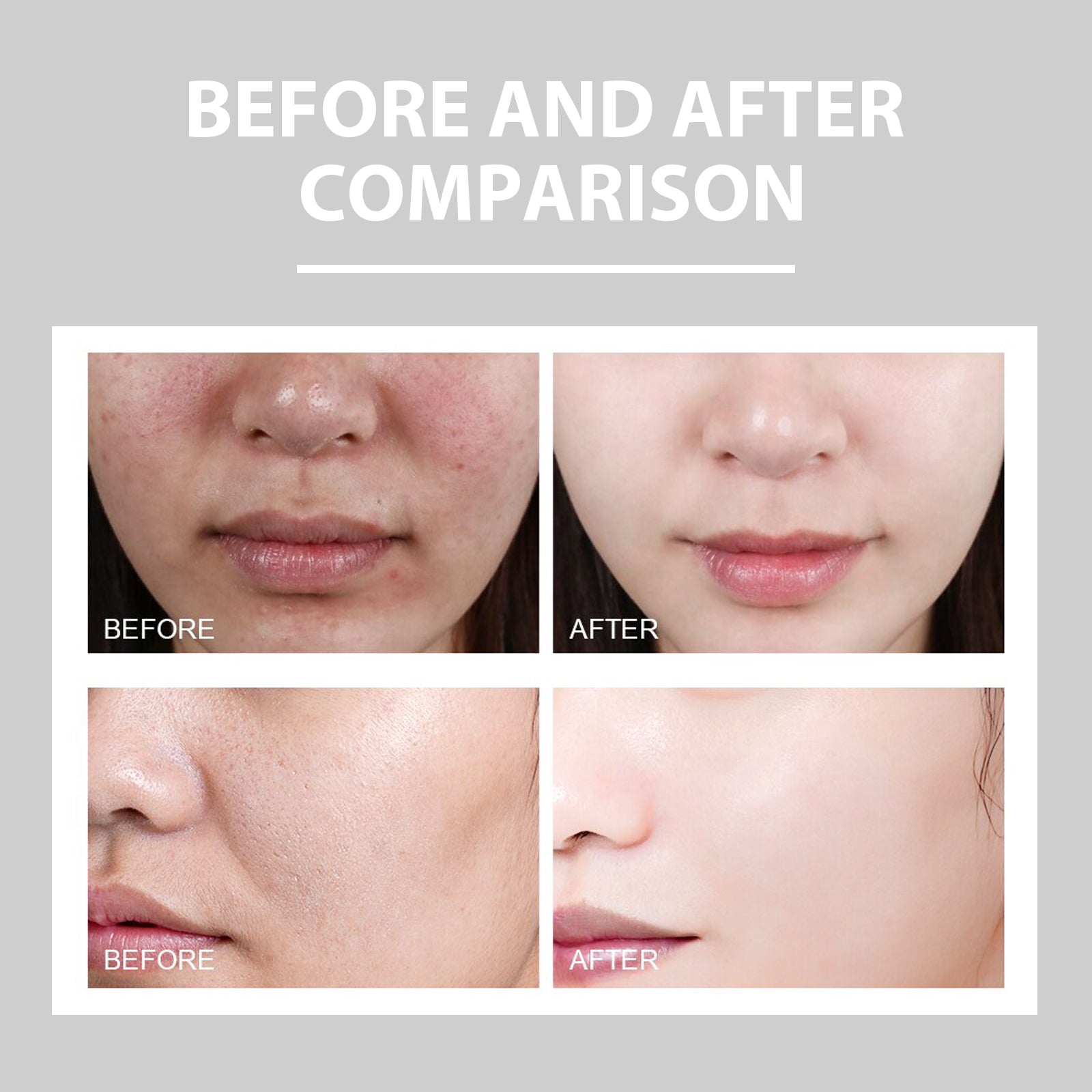 Eelhoe Hydrating Cream Hydrating And Lightening Facial Acne Repair Redness Hydrating And Brightening Moisturizing Cream - 5 - CJ
