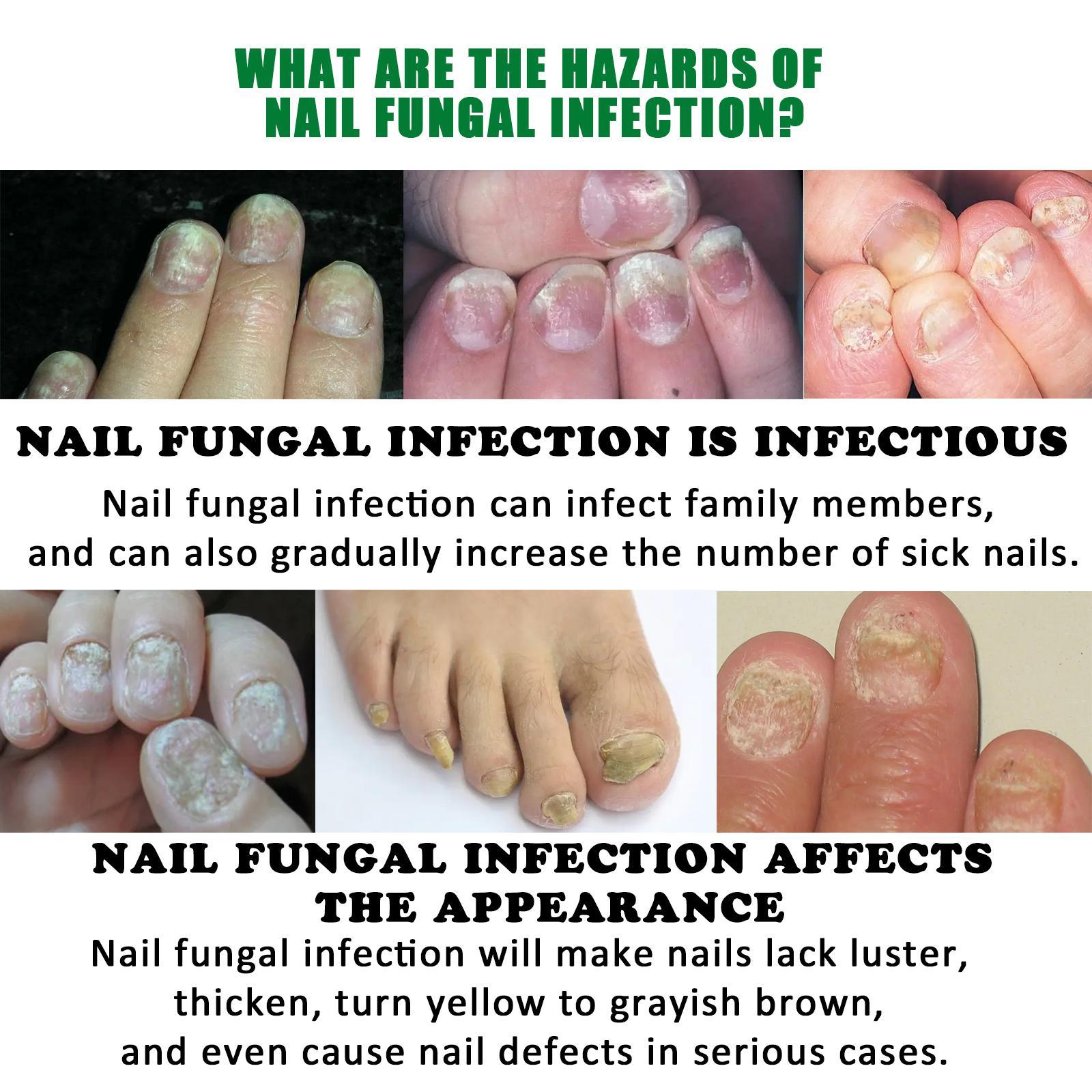 Jiasuying Ginger Nail Care Liquid, Repairs And Moisturizes Hand And Foot Nails, Makes Nails Shiny And Soft, And Improves Onychomycosis - 5 - CJ