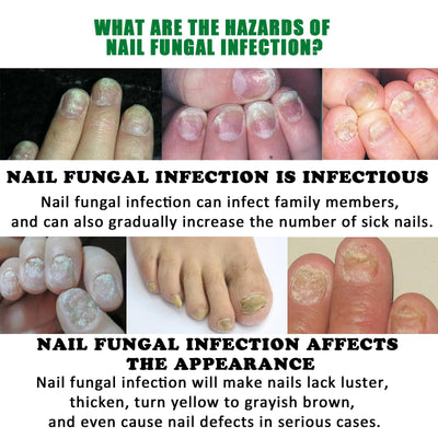 Jiasuying Ginger Nail Care Liquid, Repairs And Moisturizes Hand And Foot Nails, Makes Nails Shiny And Soft, And Improves Onychomycosis - 5 - CJ